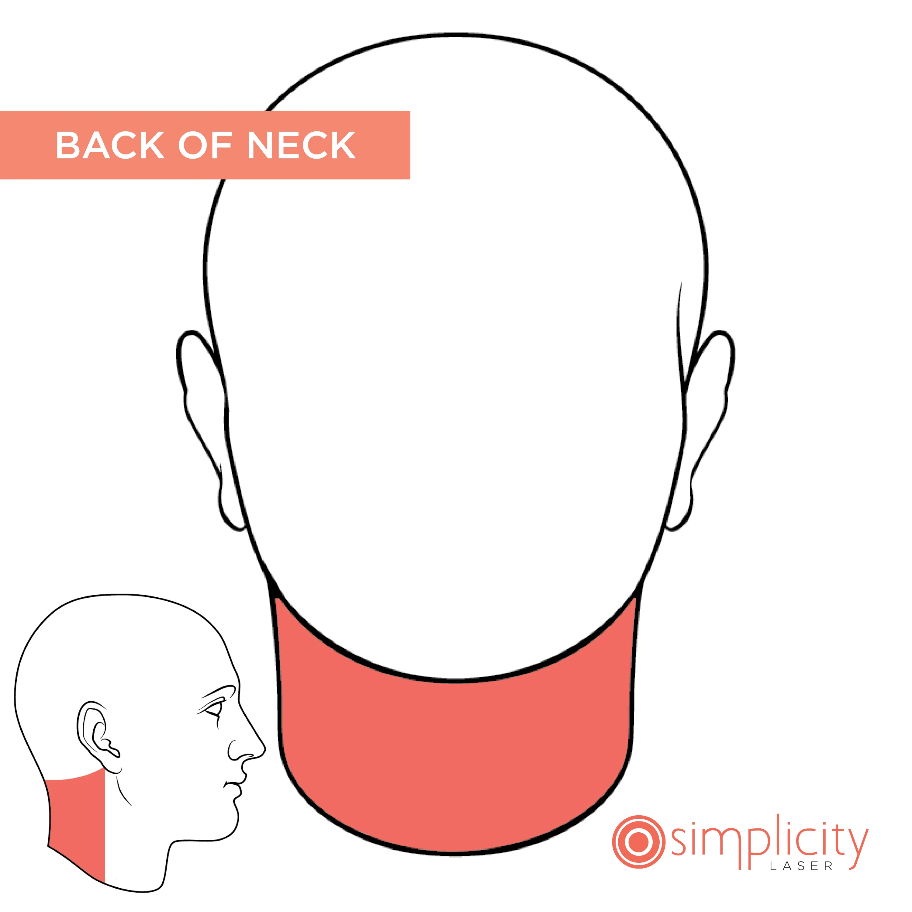 Back of Neck Women's 4-Treatment Starter Package - Image 2