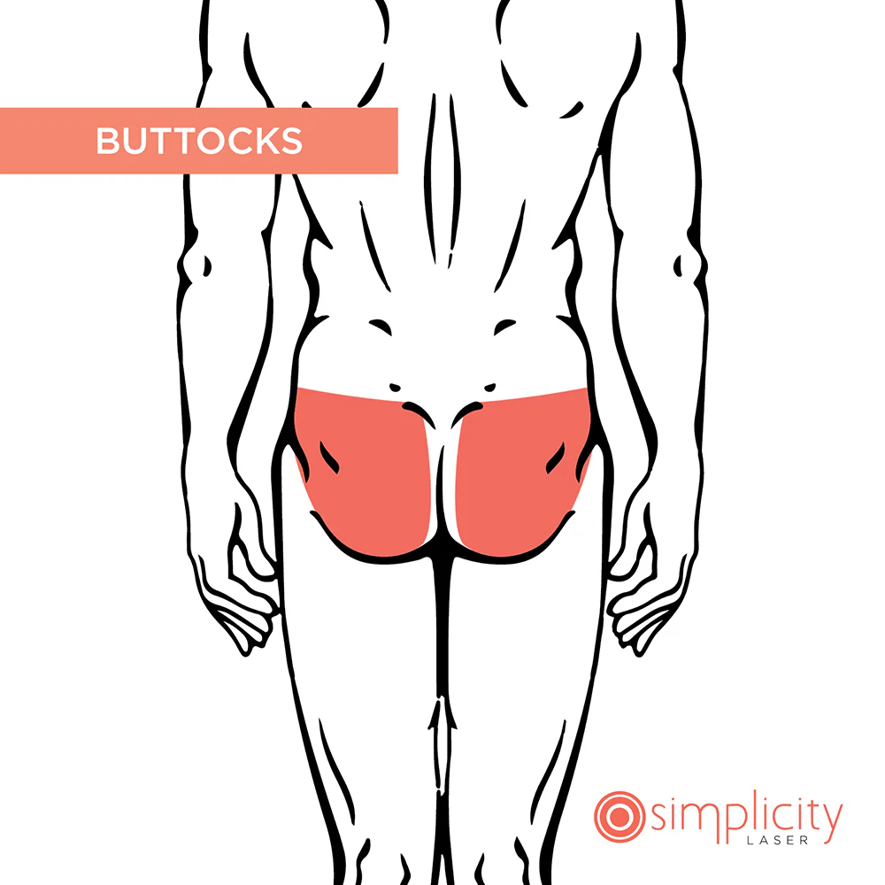 Buttocks Men's 4-Treatment Starter Package - Image 2