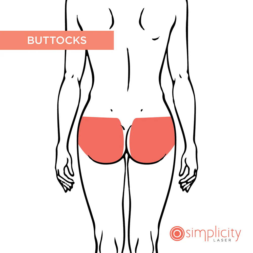 Buttocks Women's 14-Treatment Monthly Program - Image 2