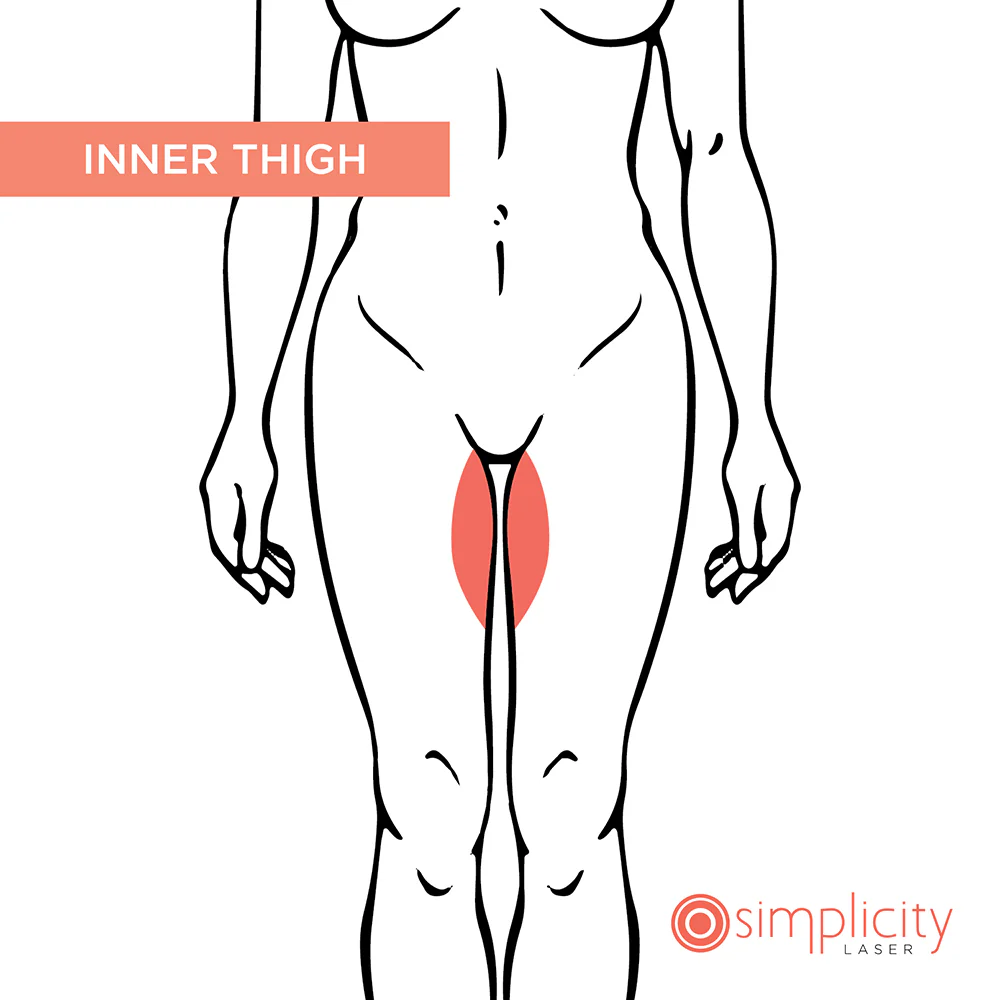 Inner Thigh Women's 14-Treatment Monthly Program - Image 2